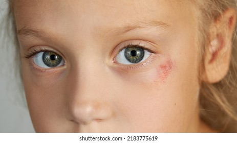 Abrasion On The Face Of A Girl's Child. Wound Under The Eye Close-up. The Concept Of Treatment Of Childhood Trauma