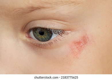 Abrasion On The Face Of A Girl's Child. Wound Under The Eye Close-up. The Concept Of Treatment Of Childhood Trauma