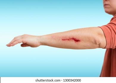 93 Bloody Scrape Arm Images, Stock Photos & Vectors | Shutterstock