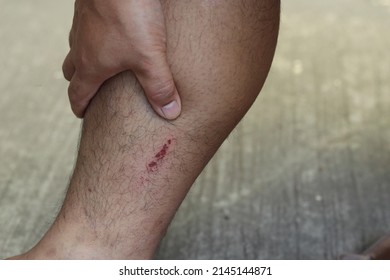 The Abrasion Was A Red Mark On The Right Calf.  There Is A Burning Sensation When Touched.