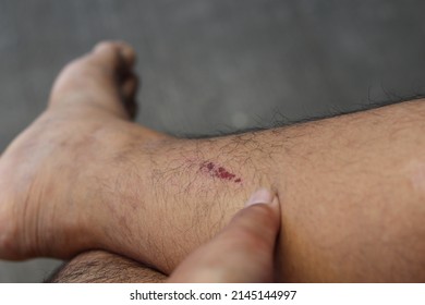 The Abrasion Was A Red Mark On The Right Calf.  There Is A Burning Sensation When Touched.