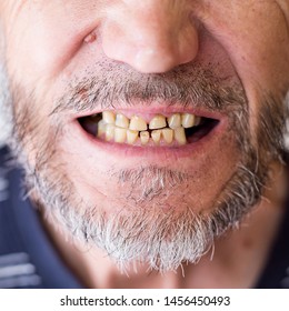 720 Abrasion dental Images, Stock Photos & Vectors | Shutterstock