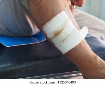 right leg abrasion wound icd 10