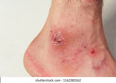 Abrasion Images, Stock Photos & Vectors | Shutterstock