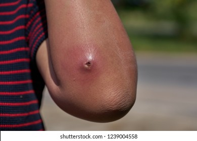 An Abscess At The Elbow