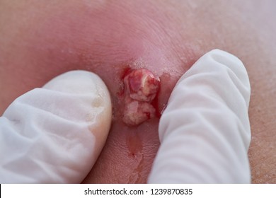 An Abscess At The Elbow