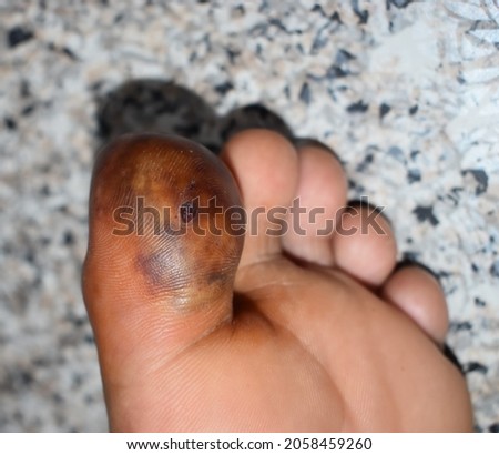 Abscess with surrounding cellulitis or Staphylococcal, Streptococcal skin infection at big toe of Asian Burmese male patient.