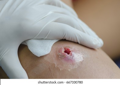 Abscess Wound.