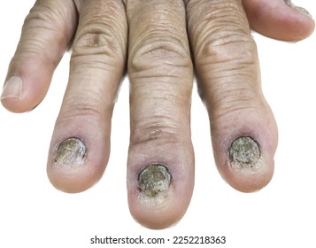 Abstract photo of fungal infection on fingernails with dry rough skin on white background. That cause nails to become discolored, thick, fragile, or cracked which calls Onychomycosis (Tinea ungium - Shutterstock ID 2252218363