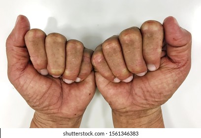 Abstract process white background photo of Hand-Foot Syndrome (Palmar-Plantar Erythrodysesthesia) in Asian man who received chemotherapy treatment in Colorectal cancer ,is Capecitabine adverse effect - Shutterstock ID 1561346383