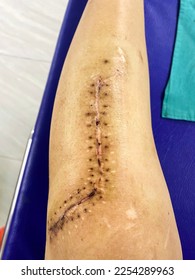Abstract soft-processed photo of lesion of surgical wound scars on leg from incision in patient who has a rough stitch mark on dry skin from surgical staple in place of sutures by orthopedic operation - Shutterstock ID 2254289963