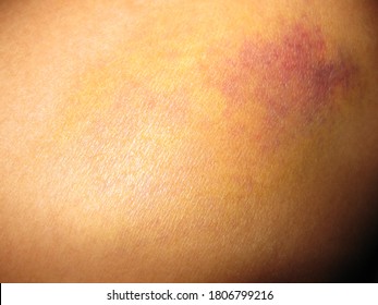Accident was bruised around knee that have hematona  - Shutterstock ID 1806799216