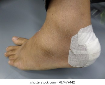 Accident Causes Heel Ulcers And First Aid.