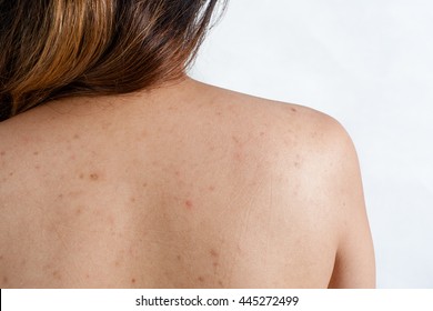 Acne Back Scar Young Red Girl