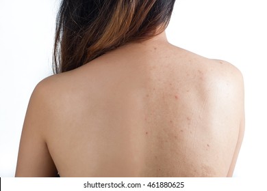 Acne Back Scar Young Red Girl Before After