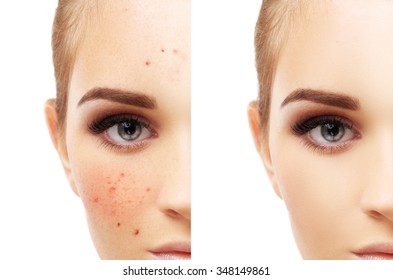 Acne, Beautiful Teenage Girl With Problem And Clear Skin 