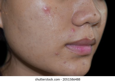 Acne , Black Spots And Scars On Oily Face Of Asian Young Woman.  Closeup View.