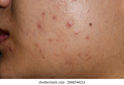 Acne , Black Spots And Scars On Face Of Asian Young Woman. 