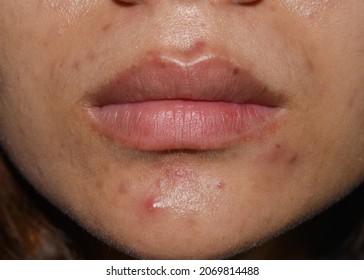 Acne, Black Spots And Scars On Face Of Asian Young Woman. 