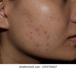 Acne, Black Spots And Scars On Face Of Asian Young Woman. 