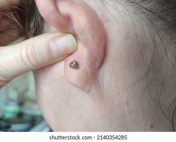 Acne Blackheads Behind An Ear