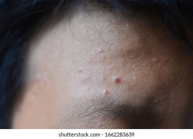 Seborrheic Dermatitis Fungal Skin Infection Scalp Stock Photo (Edit Now ...