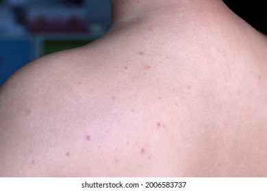 bupropion rash