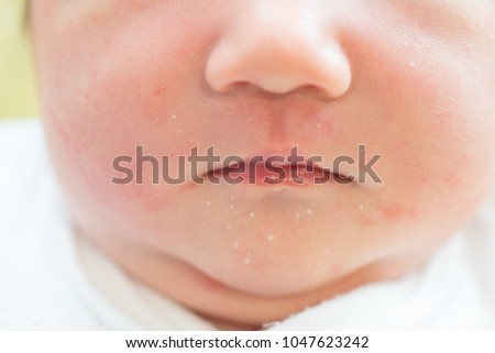 
Acne of the face of the baby