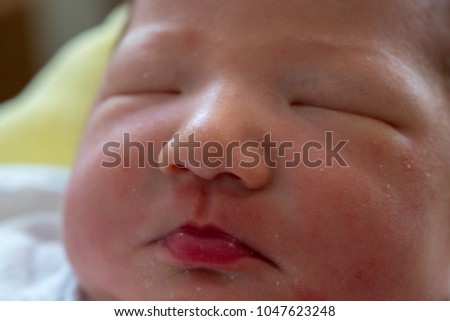 
Acne of the face of the baby