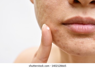 Acne And Face Skin Problem, Woman Applying Acne Cream Medication, Topical Pimple Gel Drug Treatment.