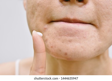 Acne And Face Skin Problem, Woman Applying Acne Cream Medication, Topical Pimple Gel Drug Treatment.