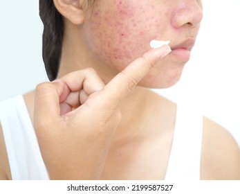 Acne And Face Skin Problem, Young Woman Applying Acne Cream Medication, Topical Pimple Gel Drug Treatment. Closeup Photo, Blurred.