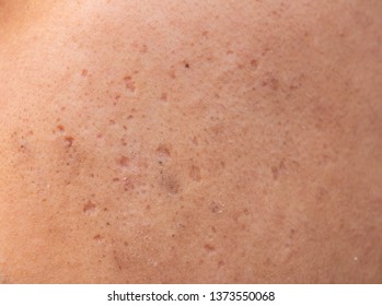 acne hole,Acne scar - Shutterstock ID 1373550068