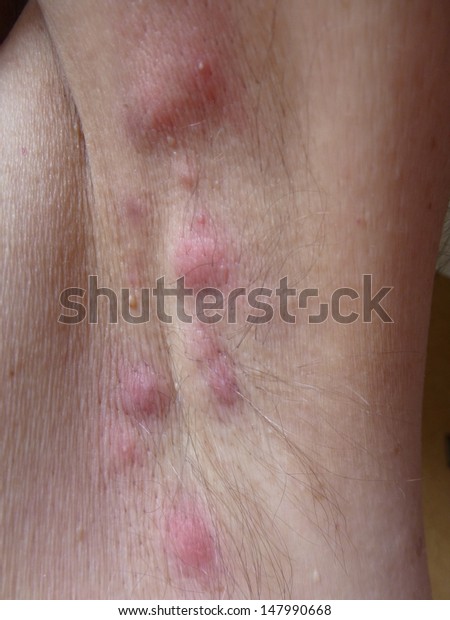 Acne Inversa Hidradenitis Suppurativa Armpit Stock Photo (Edit Now