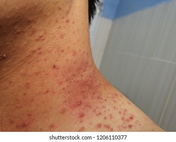 Acne On Neck Skin Dermatological Disease Acne Acne On Neck Skin Dermatological Disease Acne