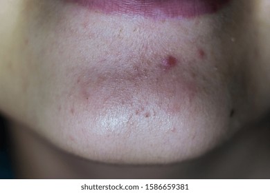 Acne On The Chin Of A Girl. Close-up.