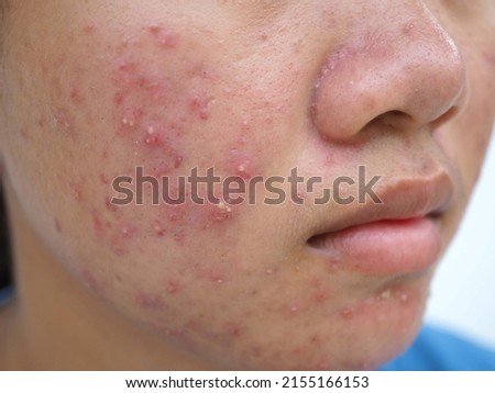 Acne on face because the disorders of sebaceous glands productions. closeup photo, blurred.