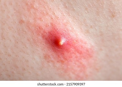 Acne On Inflamed Human Skin, Teen Body Health And Problems Of Red Pimple Close-up Texture Of Human Skin.