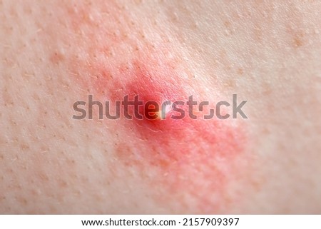 acne on inflamed human skin, teen body health and problems of red pimple close-up texture of human skin. Stockfoto © 