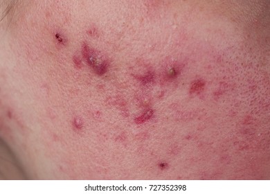 Acne On The Skin Close Up