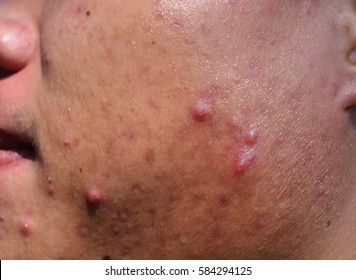 Acne On Skin Face