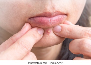 Acne pimple between mouth and chin in Asian woman skin face close up with hands to pop.