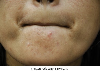 Acne Or Pimple Obstruction On Chin And Face Of Asian Thai Women