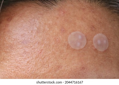 Acne Pimple Patch To Get Rid Of Zits On Face