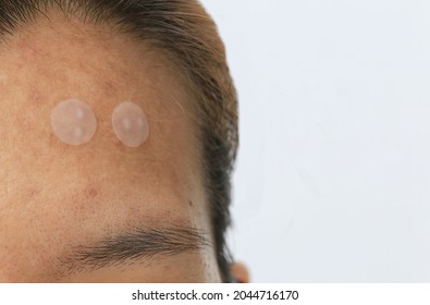 Acne pimple patch to get rid of zits on face