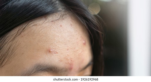 Acne Pimple Problem On Forehead In Asian Teenager Woman Skin Face Close Up.