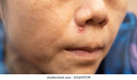 Acne Pimple Problem On Nose In Asian Woman Skin Face Close Up.