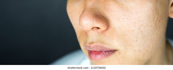 Acne Pimples Scar On Face Skin Issues, Close Up