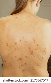 Acne Problem Concept. Teenage Girl With Problem Skin On Her Back With Pimples And Rash