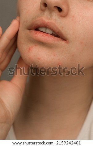 
acne problem on chin macro photo. pimples on the chin in girls. hormonal imbalance, problem skin
